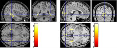Emotional Intelligence Not Only Can Make Us Feel Negative, but Can Provide Cognitive Resources to Regulate It Effectively: An fMRI Study
